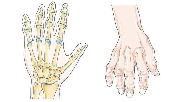 bol u tijelu zglobovima liječenje početne faze artroze ruku