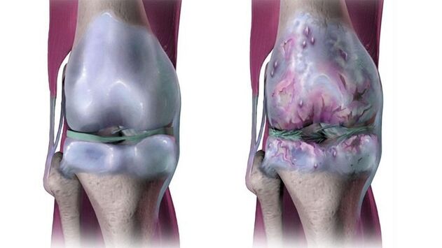 Osteoartritis: Kako izbjeći kirurški zahvat Orthokin terapijom