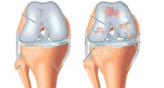 artroza zavoja zgloba koljena za njegovo liječenje moderne metode liječenja artroze i artritisa