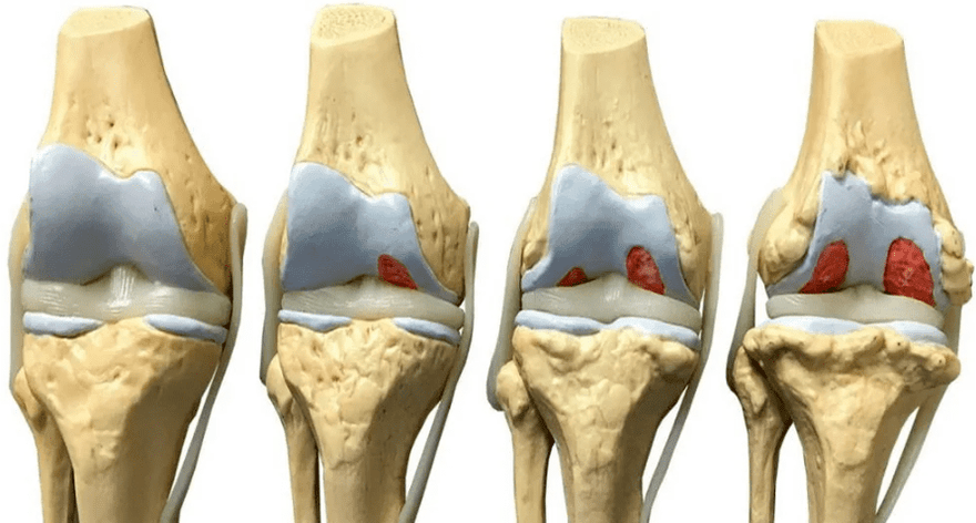 Osteoartritis: Kako izbjeći kirurški zahvat Orthokin terapijom