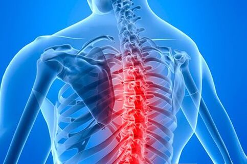 osteohondroza spondilartroza artroza liječenje zglobova koralnih kralježaka