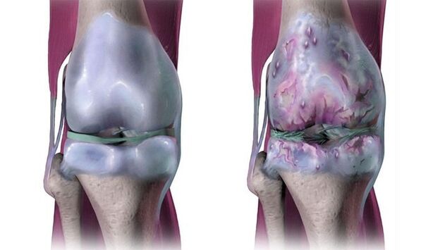 Zdrav zglob koljena i pogođen artrozom