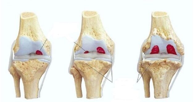 stadijumi artroze kolenskog zgloba