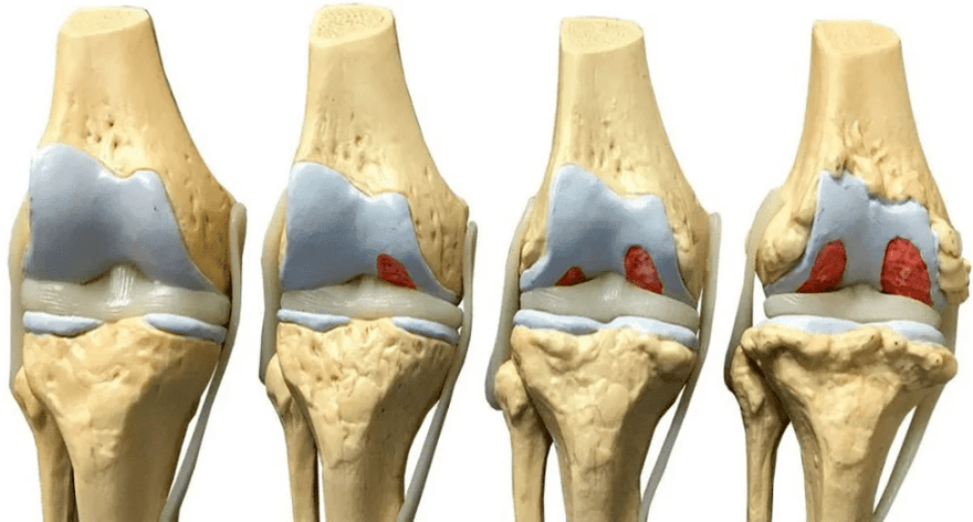oštećenje zgloba kolena u različitim fazama razvoja artroze