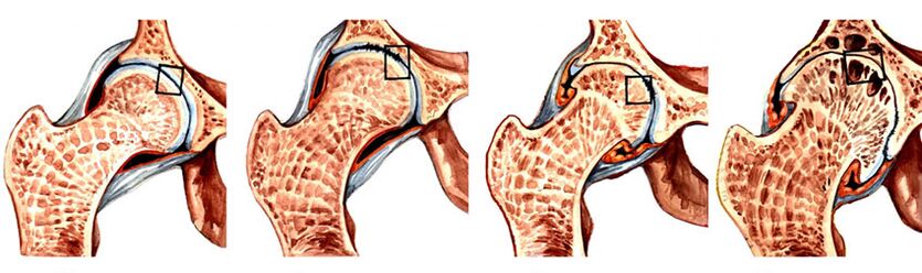 Stepen razvoja artroze zgloba kuka
