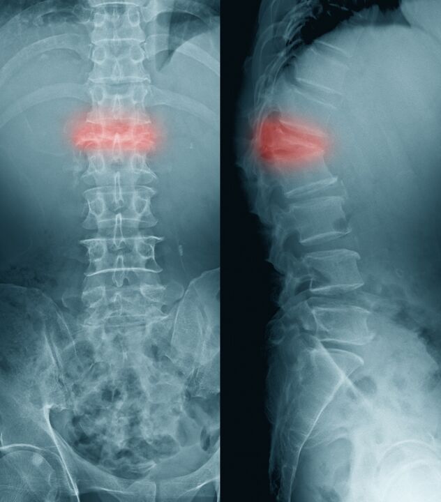 dijagnoza bolova u leđima