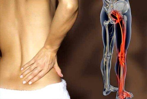 bol u donjem dijelu leđa zbog upale išijadičnog živca