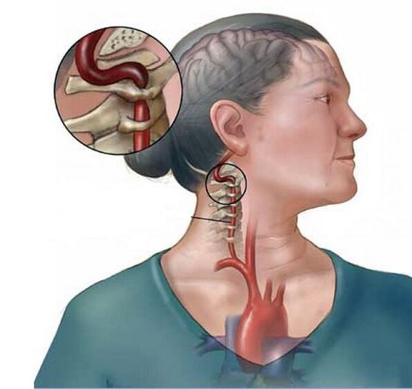 sindrom vertebralne arterije s cervikalnom osteohondrozo