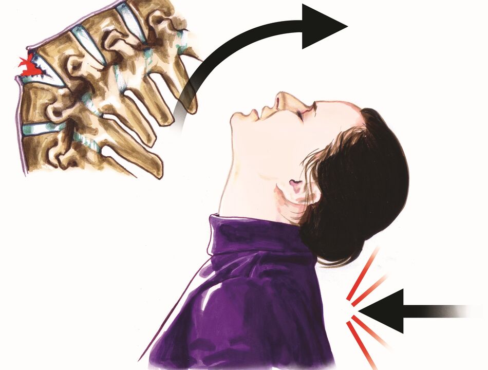 oštećenje kičme kao uzrok boli u vratu