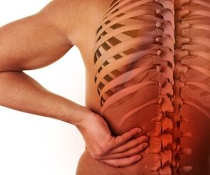 bol u leđima s lumbalnom osteohondrozo
