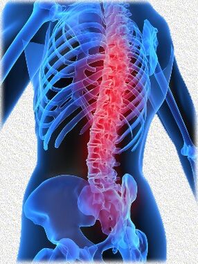 osteohondroza i metode njenog liječenja